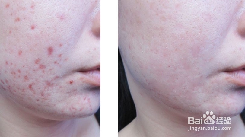 怎么用ps清除图片上的污点 痘痘