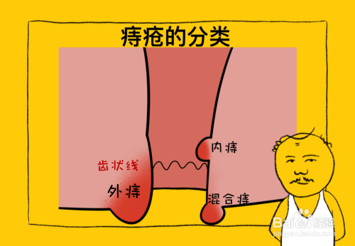 痔疮的主要症状