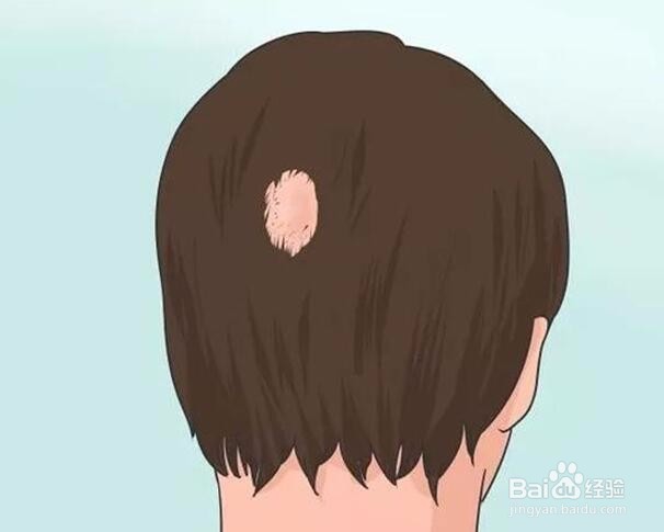 斑秃治疗后为什么长白头发、长毛毛原因