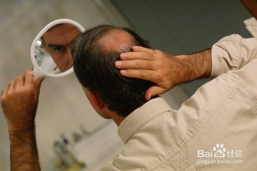 男性偶发性斑秃预防和生发方法