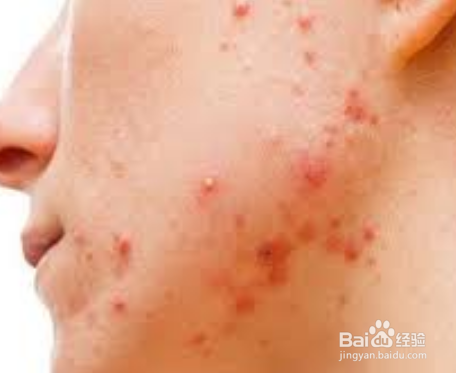 皮肤科医生揭示痤疮的主要原因