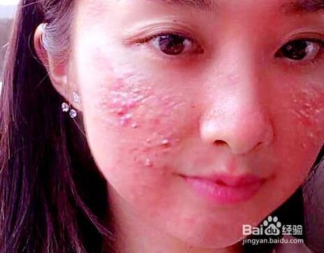 激素脸和过敏脸如何区分,怎么治疗