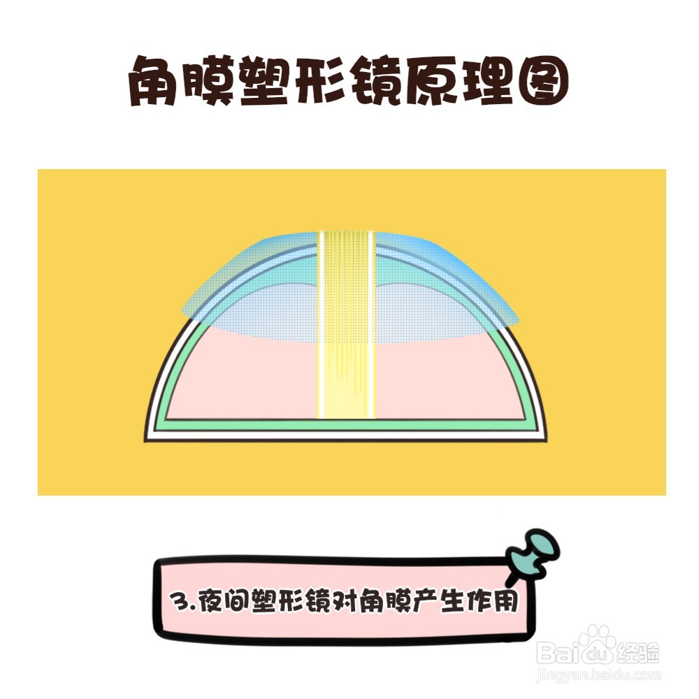 角膜塑形镜的原理