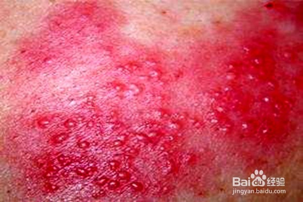 带状疱疹前期症状