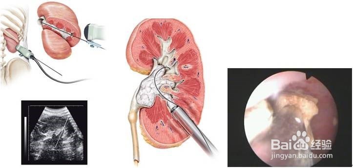 中药治疗肾结石的一般方法和原则