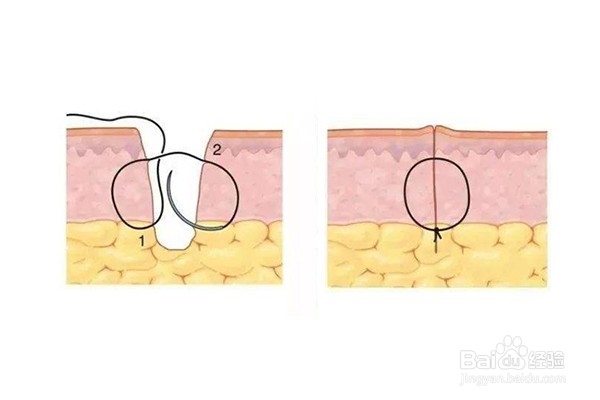 窦道型褥疮治疗最佳方法