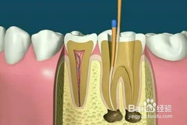 牙齿根管治疗后，为何还痛？
