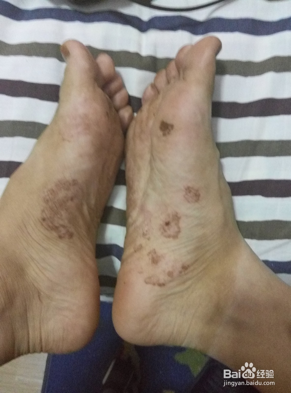 自己用高锰酸钾治疗脚气病经验分享