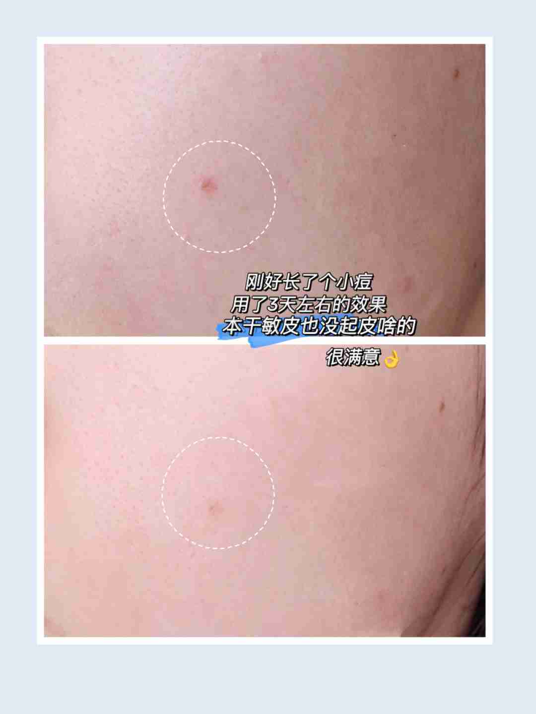 garancia无酸精华！一款适合有油痘肌的宝藏