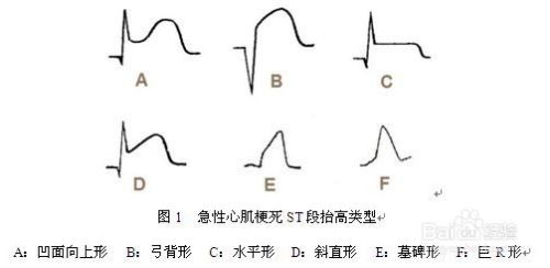 st段异常 全网资源