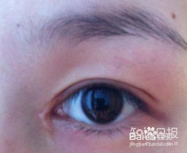 开眼角手术后留下明显疤痕，该怎么办