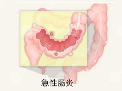 急性肠炎的症状