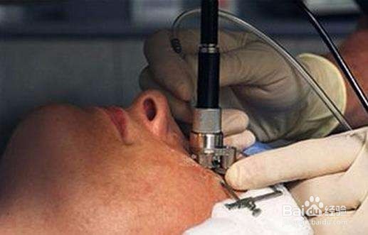 关于视力矫正手术的有关知识