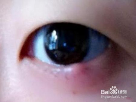 长了麦粒肿,要不要挤破了事呢