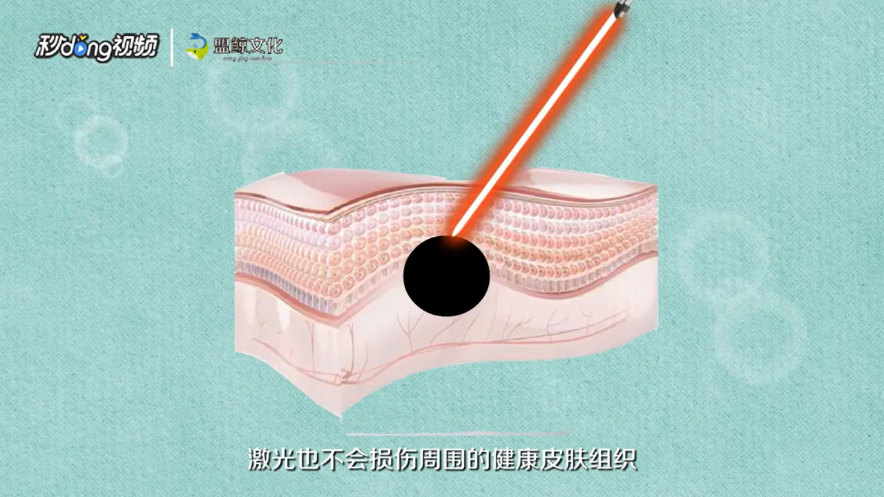 面部去痣有哪些方法