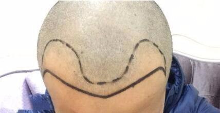 鬓角种植前怎么做不会留下疤痕