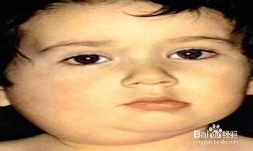 春季怎样防治腮腺炎？