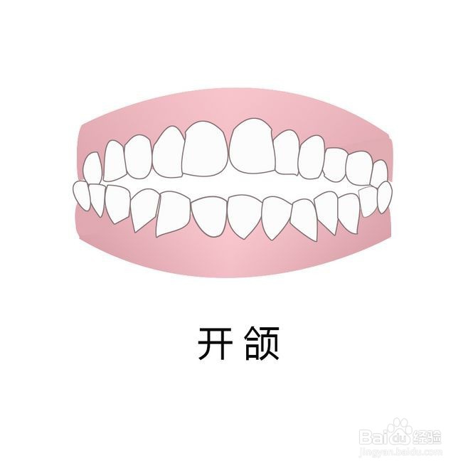 牙齿矫正类型图片