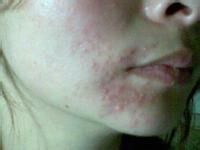 脸上花粉过敏怎么办