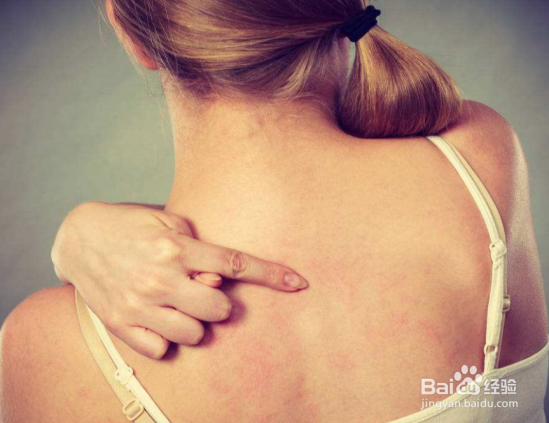 治疗湿疹用什么药膏好?怎么治疗湿疹比较好?