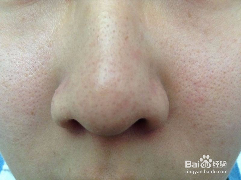 黑头的原因及护理方法