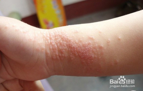 三岁宝宝起湿疹怎么办