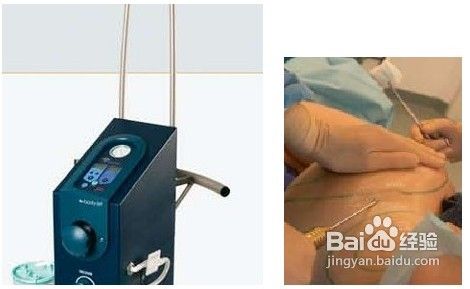 水动力吸脂对比图