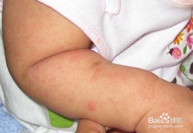 孩子过敏的应对方法