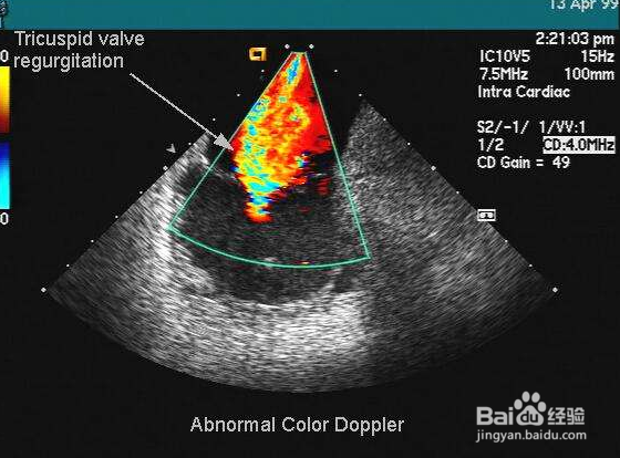 初生婴儿要不要做心脏彩超及注意事项