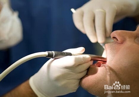 洗牙要多长时间