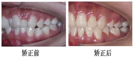 龅牙的价格是多少?