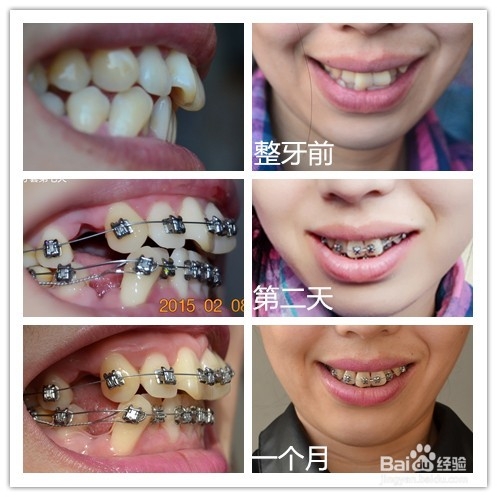 <b>牙齿矫正：[6]北京301医院带牙套一个月对比</b>