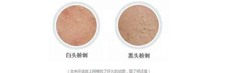 黑头其实并不难去除！用对方法就可以！