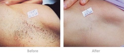 激光脱毛的优势有那些