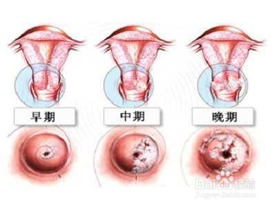 <b>宫颈癌手术后食谱如何安排</b>