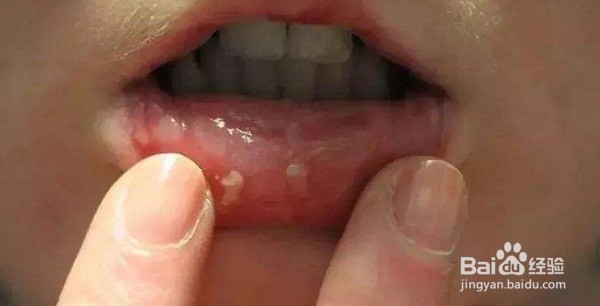 如何缓解口腔溃疡？