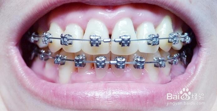 牙齿矫正中，带牙套一年的变化对比图