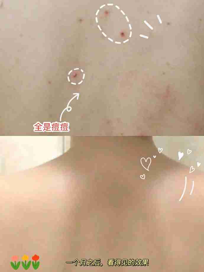 专为痘肌定制的身体清洁沐浴露!