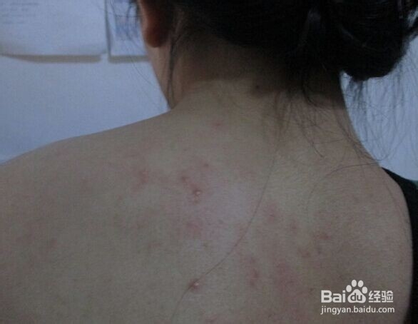 背部长痘痘的最佳办法