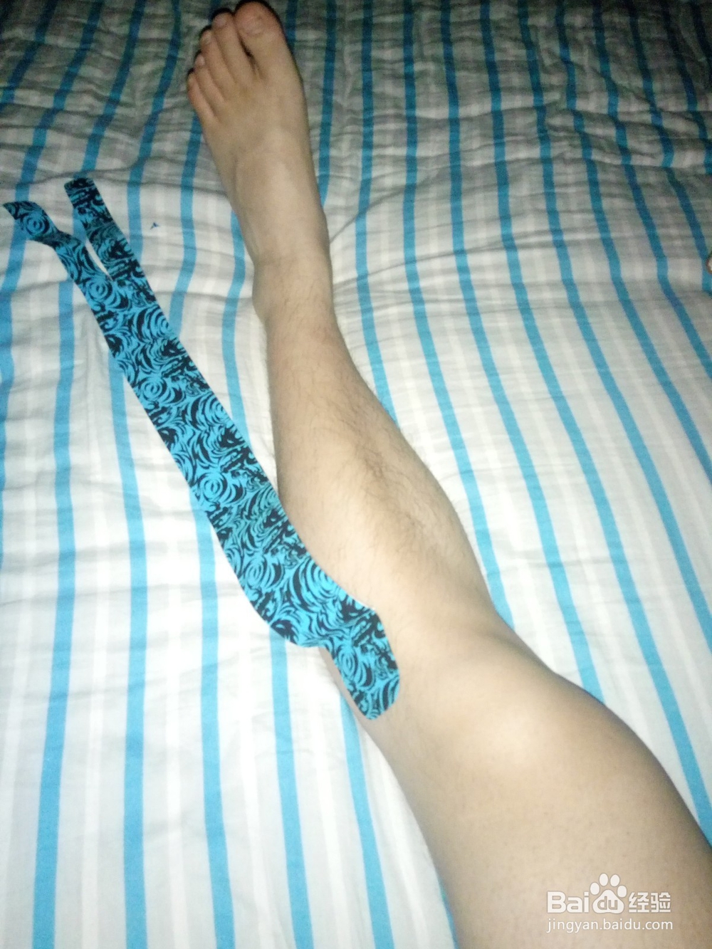 脑卒中后足下垂内翻的贴扎治疗