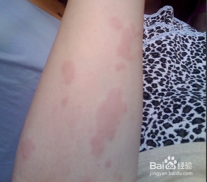 慢性荨麻疹引起的原因