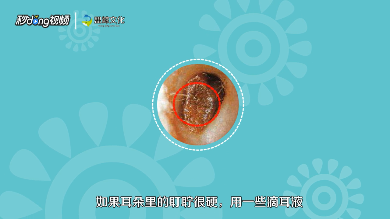 耳屎掉到耳膜上怎么办