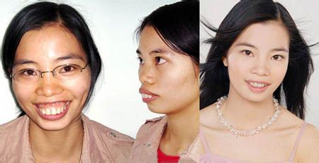 龅牙的价格是多少?