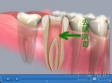 补牙的三个具体步骤