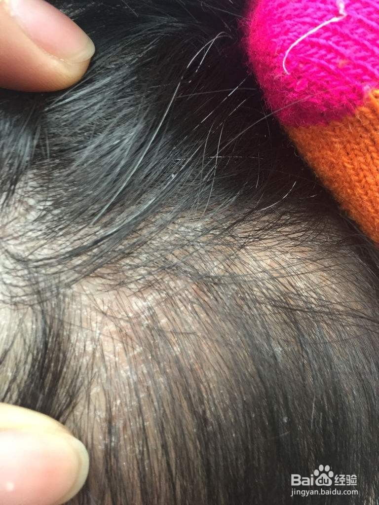 女生掉头发可能是这几个原因以及对应方法