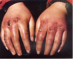 手上生冻疮怎么治疗