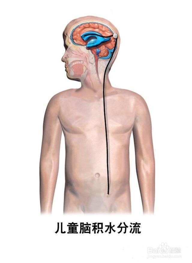 什么是颅内感染