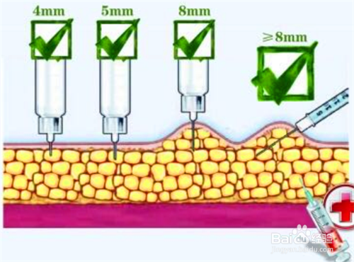 图文详解如何正确规范注射胰岛素