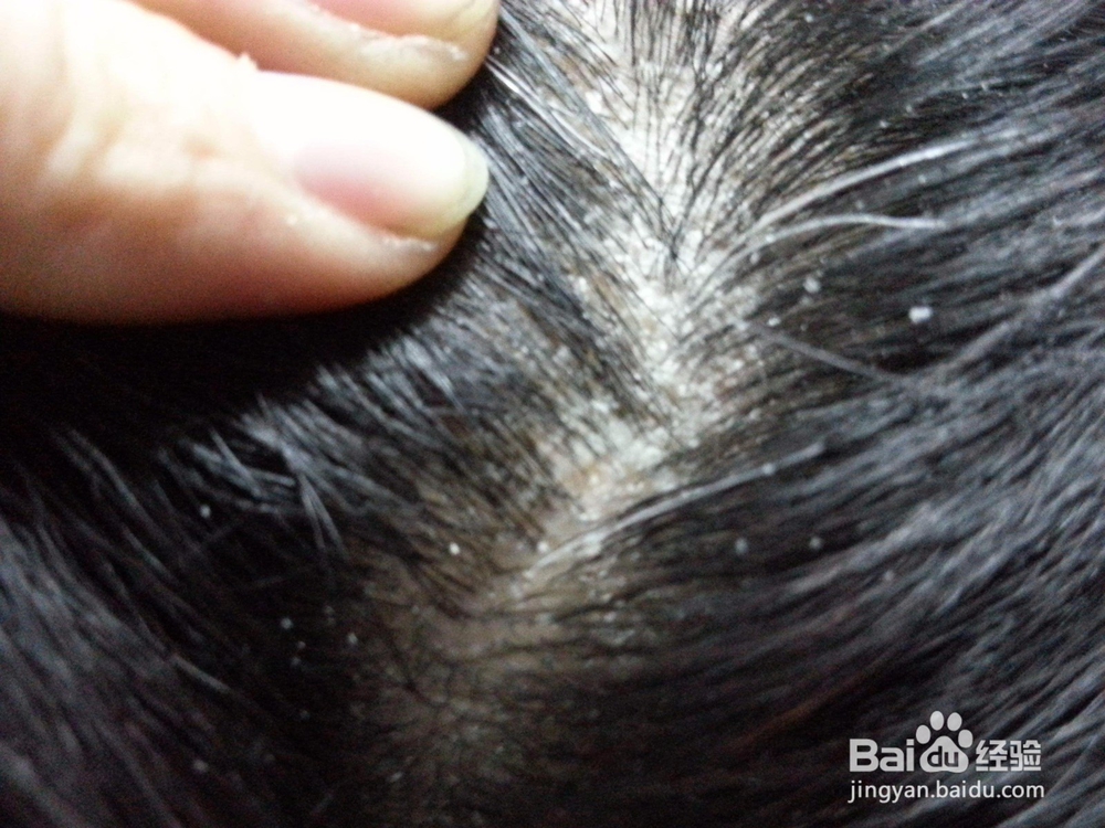 怎样去除头皮屑