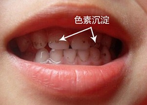 洗牙是最便宜的治疗